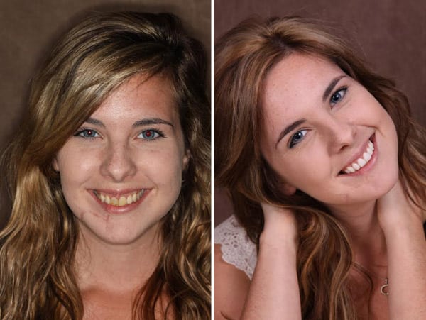 What a Graceful Smile Makeover Looks Like