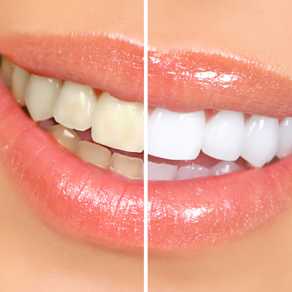 A picture with teeth before and after teeth whitening procedure 